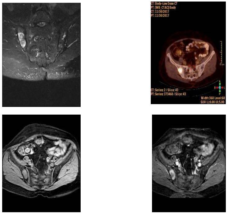 CASE 14:  Iliac Wing Posterior Chondrosarcoma
