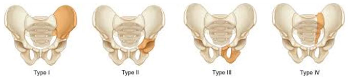 internal hemipelvektomi tipleri