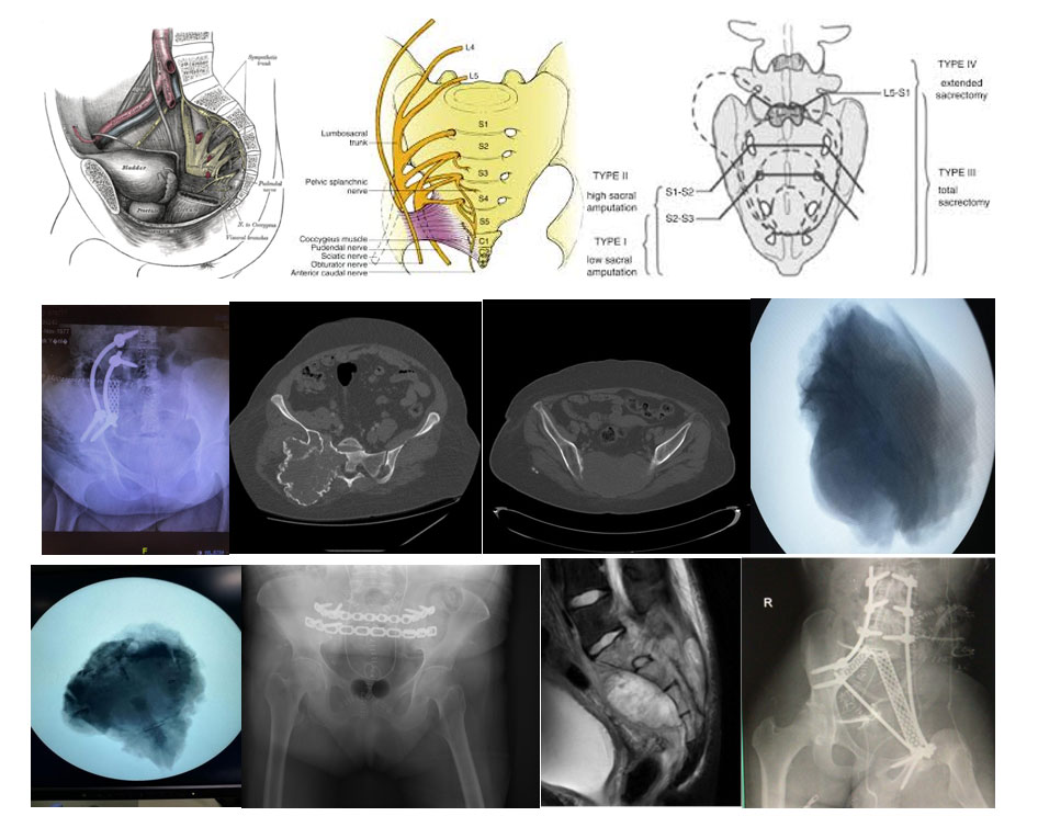 sarkum tumorleri sakrektomi 02