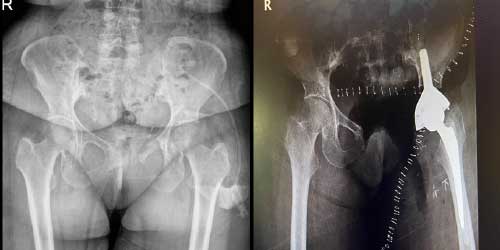 Vaka 24: Sol Pubik Kol Ve Asetabulum Yerleşimli Osteosarkom