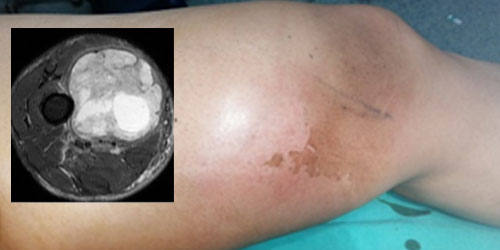 Fibrosarkom - Mikrofibrosarkom