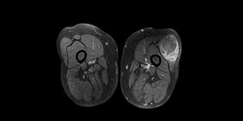 İndiferansiyepleomorfik Sarkom - Malign Fibröz Histiotizm