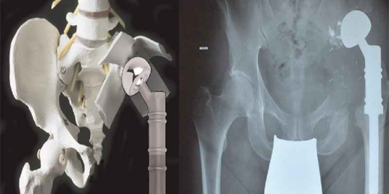 Kemik Sarkomlarında Tümörlü Kemiğin Çıkarılması (Rezerksiyon) Sonrası Oluşan Boşluğun Yeniden Yapılandırılması (Rekonstrüksiyon) Yöntemleri