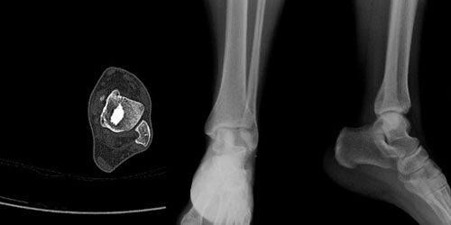 Kemik Adacığı - Osteopoikilozis - Melorheostozis