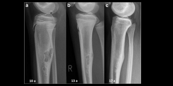 Kemik Tümörünün 5 Belirtisi