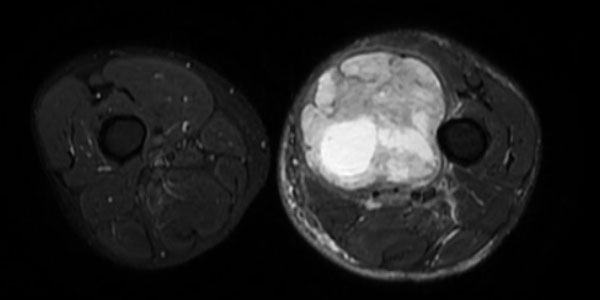 Kötü Huylu Yumuşak Doku Tümörleri (Yumuşak Doku Sarkomları)
