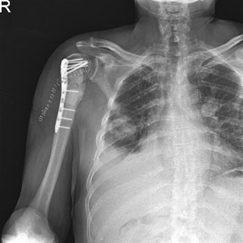 Ameliyat sonrası çimento ve titanyum plak uygulanmış röntgen görüntüsü