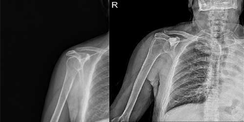 Vaka 1: Akciğer Kanseri Sağ Kürek Kemiği (Skapula) Metastazına Bağlı Kırık Riski