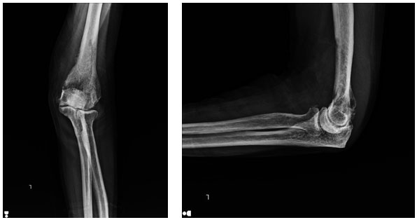 Akciğer Kanseri Kol Kemiği Metastazı | Distal Humerus Protez Uygulaması
