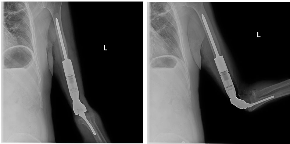 Akciğer Kanseri Kol Kemiği Metastazı | Distal Humerus Protez Uygulaması
