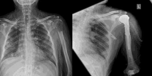 Vaka 2: Böbrek (Renal Hücreli) Kanser Kol (Humerus) Kemiği Metastazı
