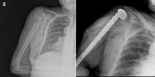 Vaka 3: Akciğer Kanseri Sağ Kol (Humerus Üst Uç) Kemiği Metastazına Bağlı Kırık