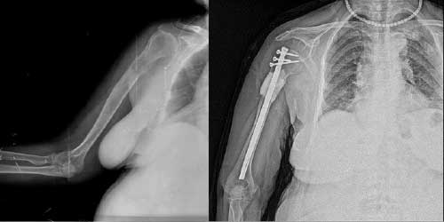 Vaka 4: Böbrek Kanseri (RCC_Renal Hücreli Kanser) Sağ Kol (Humerus) Metasazına Bağlı Kırık Riski