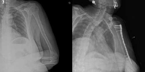 Vaka 5: Meme Kanseri Sol Kol (Humerus) Kemiği Metastazına Bağlı Kırık
