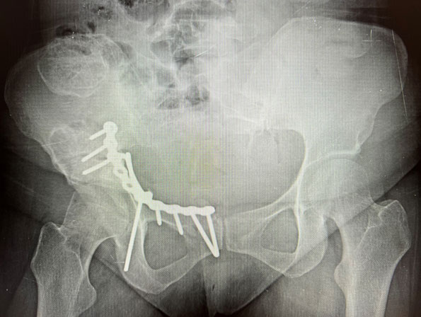 Pararectus insizyon hattının planlanması, kırığın yerleştirilmesi ve anatomik titanyum plak ile sabitlenmesi görülmekte.