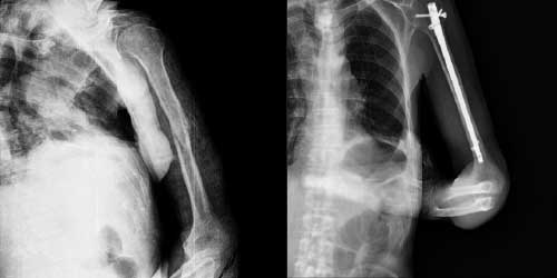 Vaka 7: Böbrek (Renal hücreli) Kanseri Sağ Kol (Humerus) Kemiği Metastazına Bağlı Kırık