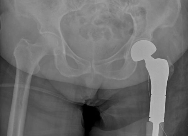 Ameliyat sonrası: Röntgende proksimal femur rezeksiyonu ve tümör protezi görülmekte