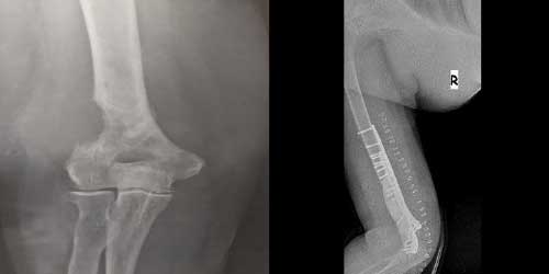 Vaka 8: Mide Kanseri Sağ Kol Kemiği (Humerus) Metastazına Bağlı Kırık Riski