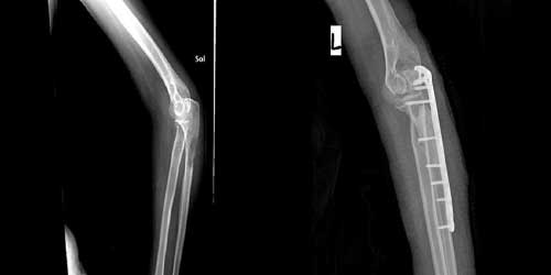 Vaka 10: Böbrek Kanseri (Renal Hücreli) Sağ Dirsek Kemiği (Proksimal ulna) Metastazına Bağlı Kırık Riski