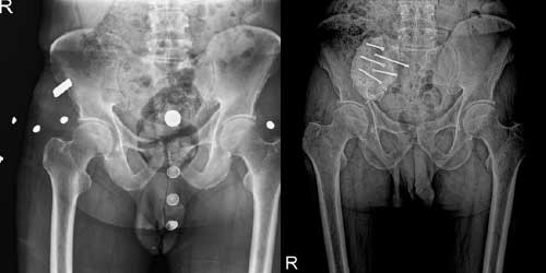 Vaka 11: Akciğer Kanseri Leğen Kemiği (İliak Kanat) Metastazı