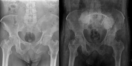 Vaka 12: Böbrek Kanseri (Renal Hücreli) Leğen Kemiği (Pelvis) Metastazı