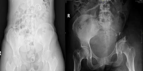 Vaka 13: Rahim Ağzı (Serviks) Kanseri Sol Leğen Kemiği (Sakroiliak Eklem) Metastazı