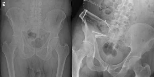 Vaka 14: Tiroid Kanseri Leğen Kemiği (Pelvis) Metastazı