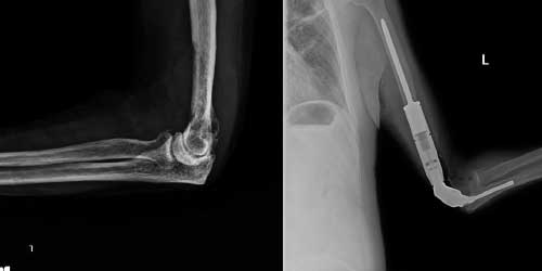 Vaka 9: Akciğer Kanseri Kol Kemiği (Humerus) Metastazına Bağlı Kırık Riski