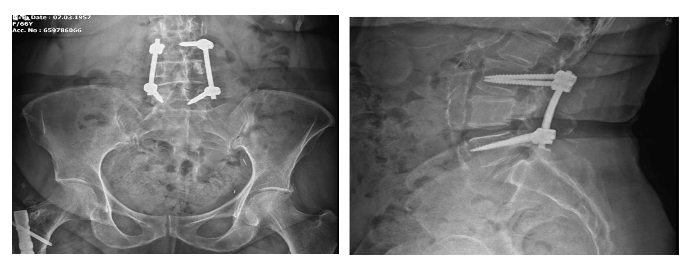 Ameliyat öncesi MR görüntüsü