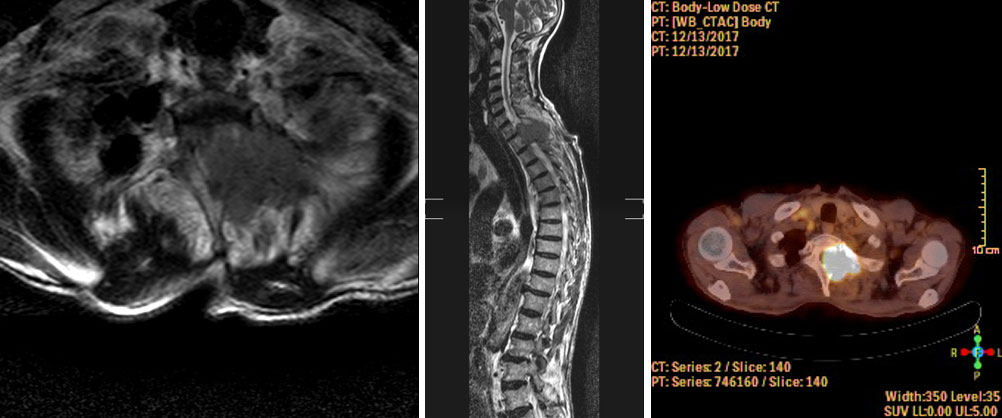 MR ve PET-CT bulguları – torakal omurga metastazı