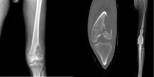 Vaka 30: Diz (Distal femur) Yerleşimli Osteosarkom