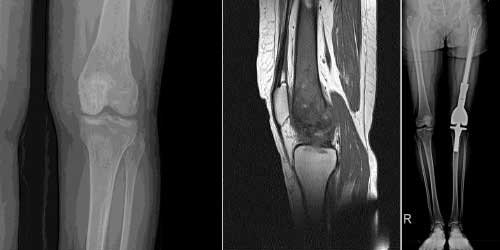 Vaka 31: Diz (Distal Femur) Yerleşimli Osteosarkom
