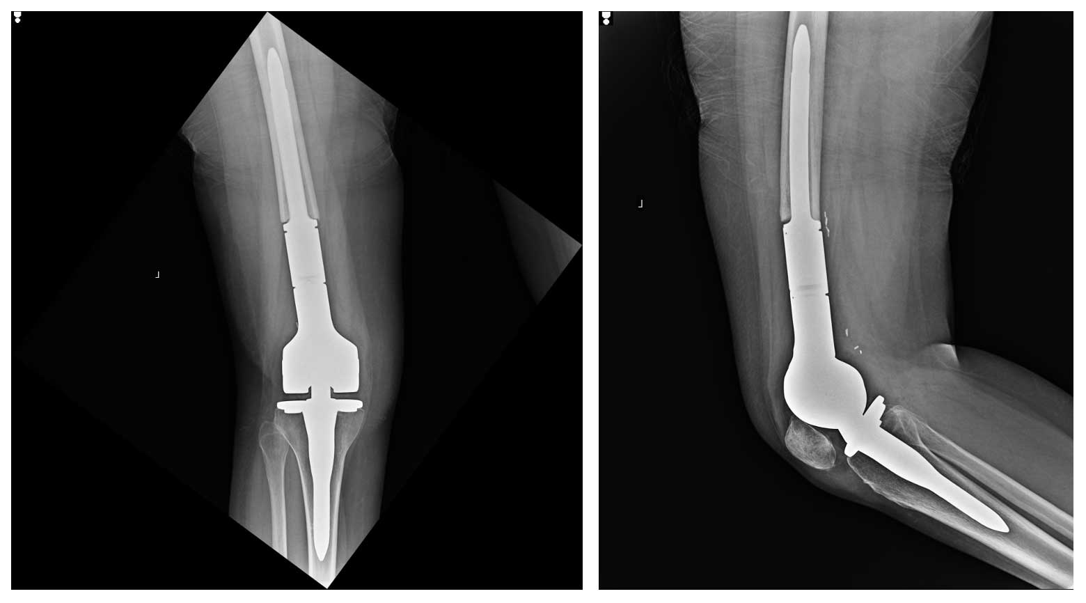 osteosarkom 32 5