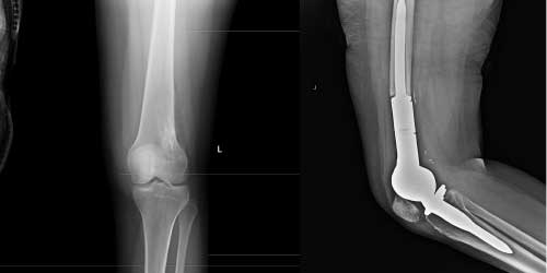 Vaka 32: Distal Femur Osteosarkom