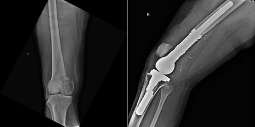 Vaka 33: Distal Femur Yerleşimli Osteosarkom