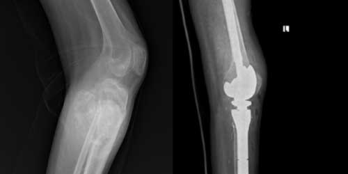 Vaka 34: Diz (Proksimal Tibia) Yerleşimli Osteosarkom
