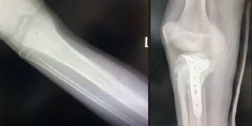 Vaka 35: Kaval Kemiği (Tibia) Yerleşimli Osteosarkom