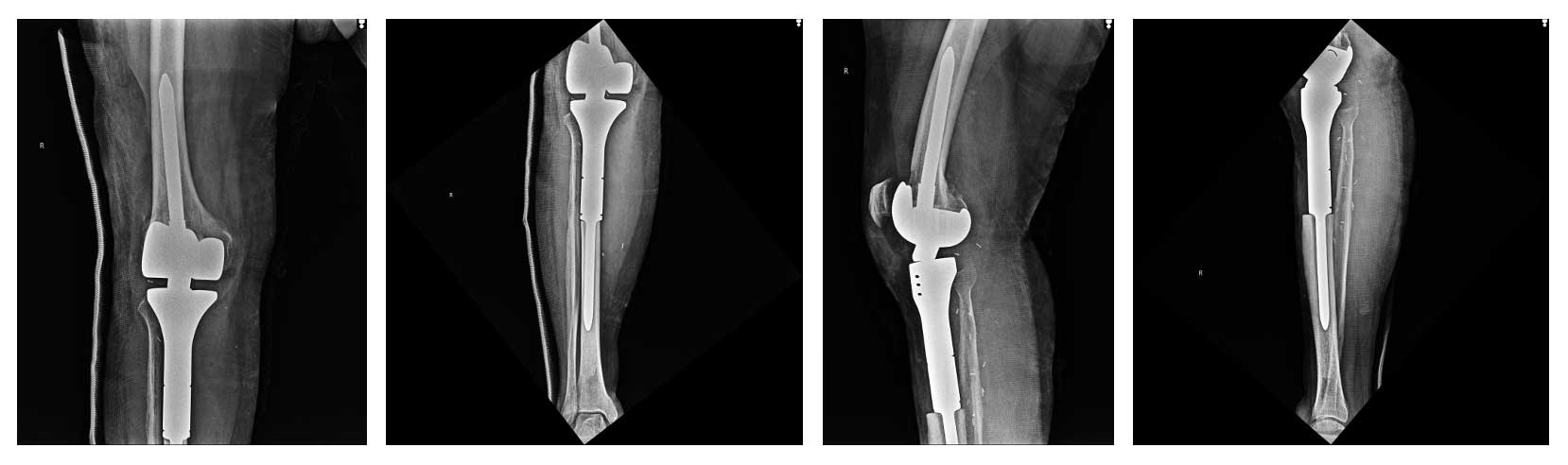 osteosarkom 32 5