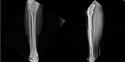 Vaka 36: Proksimal Tibia Osteosarkom