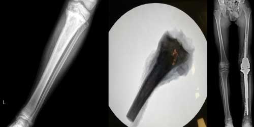 Vaka 37: Kaval Kemiği (Proksimal Tibia) Yerleşimli Osteosarkom