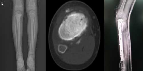 Vaka 38: Kaval kemiği (Tibia) Yerleşimli Osteosarkom