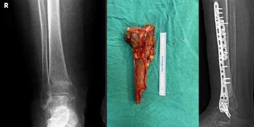 Vaka 39: Ayak Bileği (Distal Tibia) Yerleşimli Osteosarkom