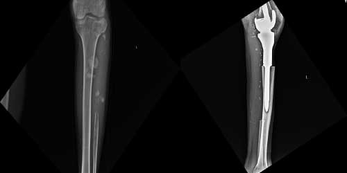 Vaka 40: Sol Proksimal Fibula Nüks Osteosarkom