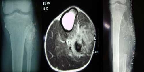 Vaka 41: Diz (Proksimal Fibula) Yerleşimli Osteosarkom