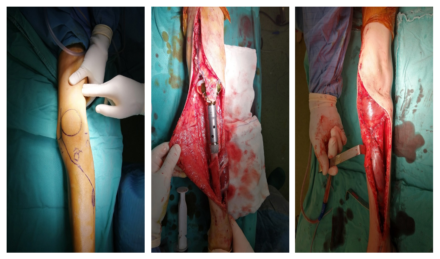 osteosarkom 42 3 gercek