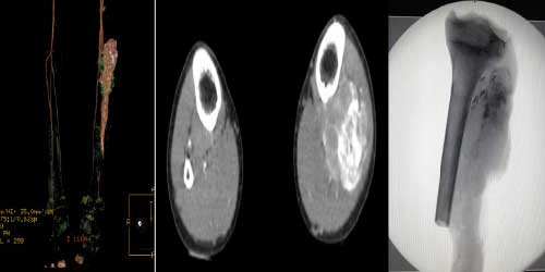 Vaka 42: Bacak (Fibula+Tibia) Yerleşimli Osteosarkom