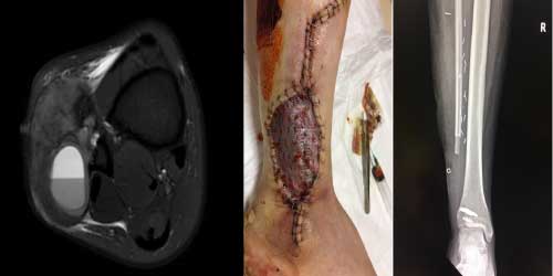 Vaka 43: Ayak bileği (Distal Fibula) Yerleşimli Osteosarkom