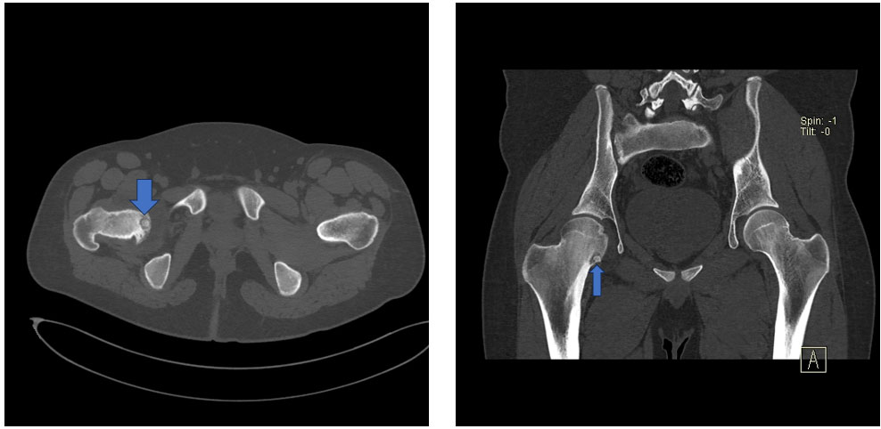 İşlem öncesi tomografi – osteoid osteoma
