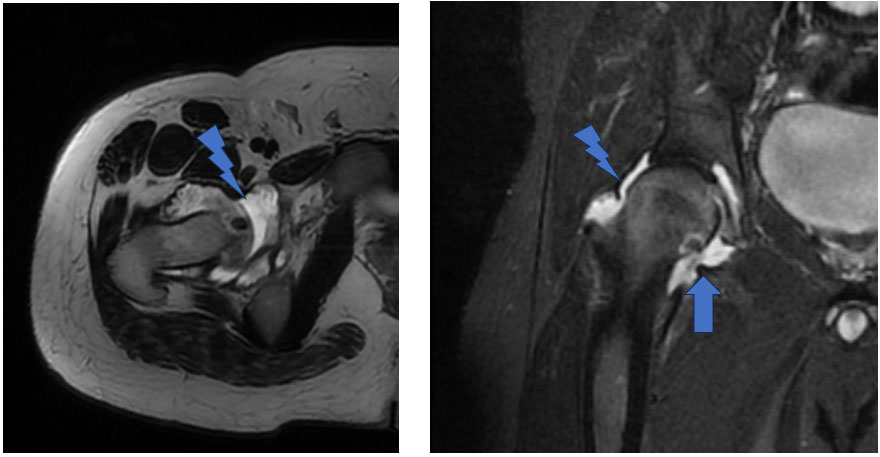 İşlem öncesi MR – osteoid osteoma