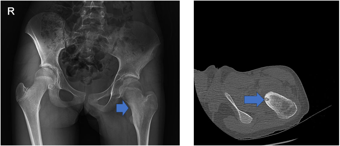 İşlem Öncesi – Röntgen ve Tomografi: Tipik nidus ve çevreleyen sklerotik alan görünmekte